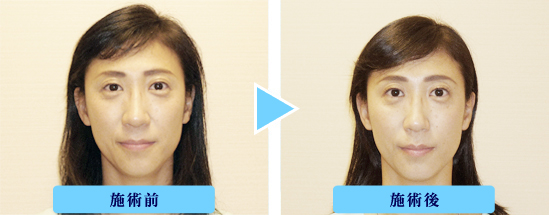 ���e�I�i�����I�j�{�p�O��